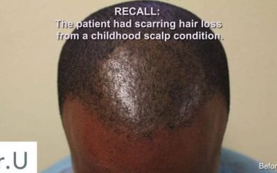 uncovering the success of hair restoration surgery