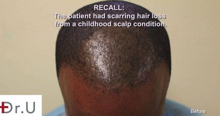 uncovering the success of hair restoration surgery