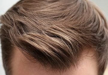 understanding hair transplant benefits and risks